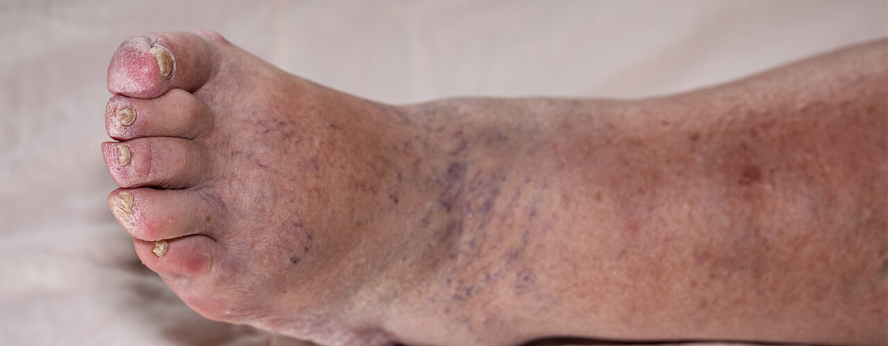 Lymphedema Laredo, TX